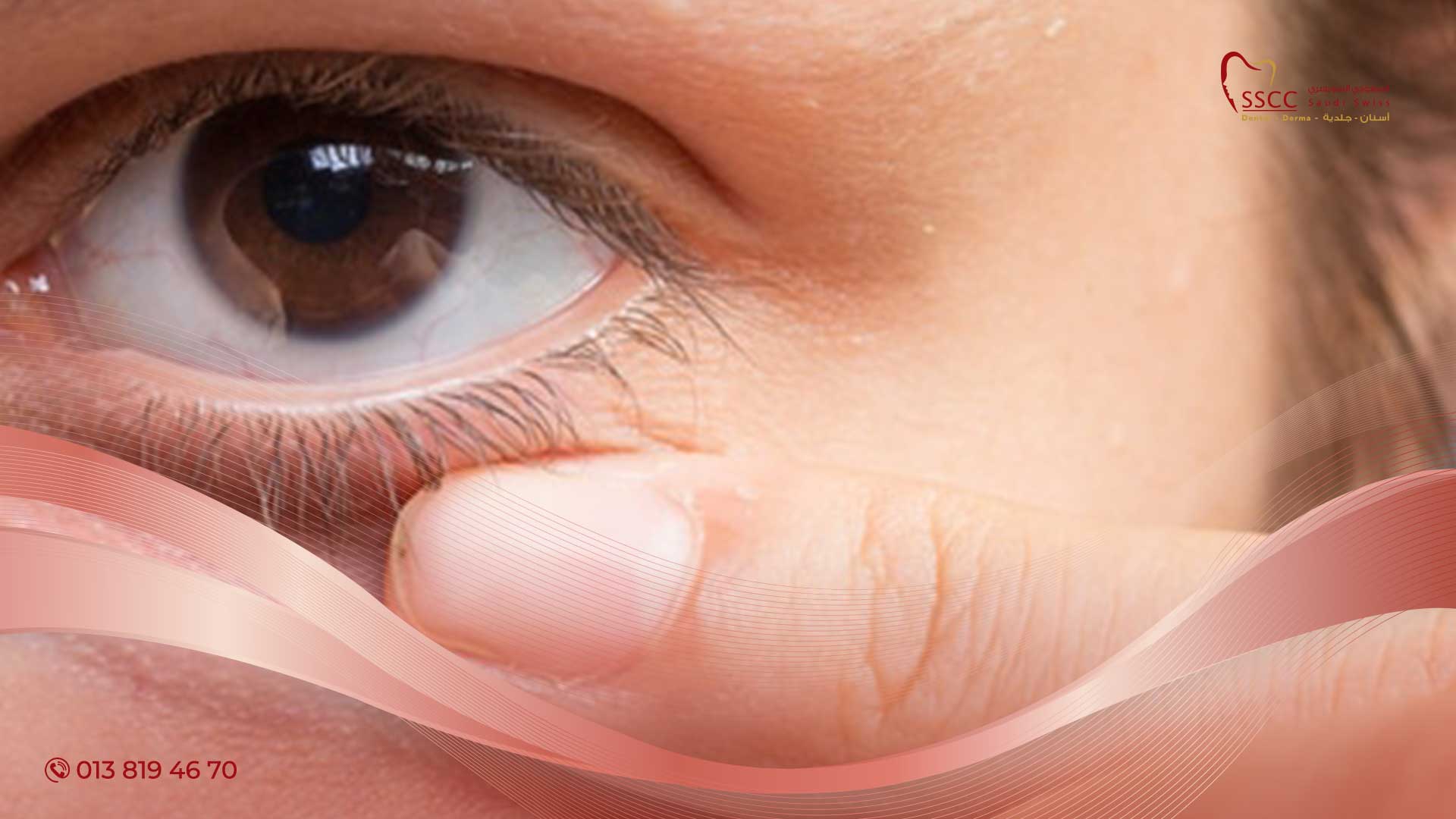 علاج تورم العين