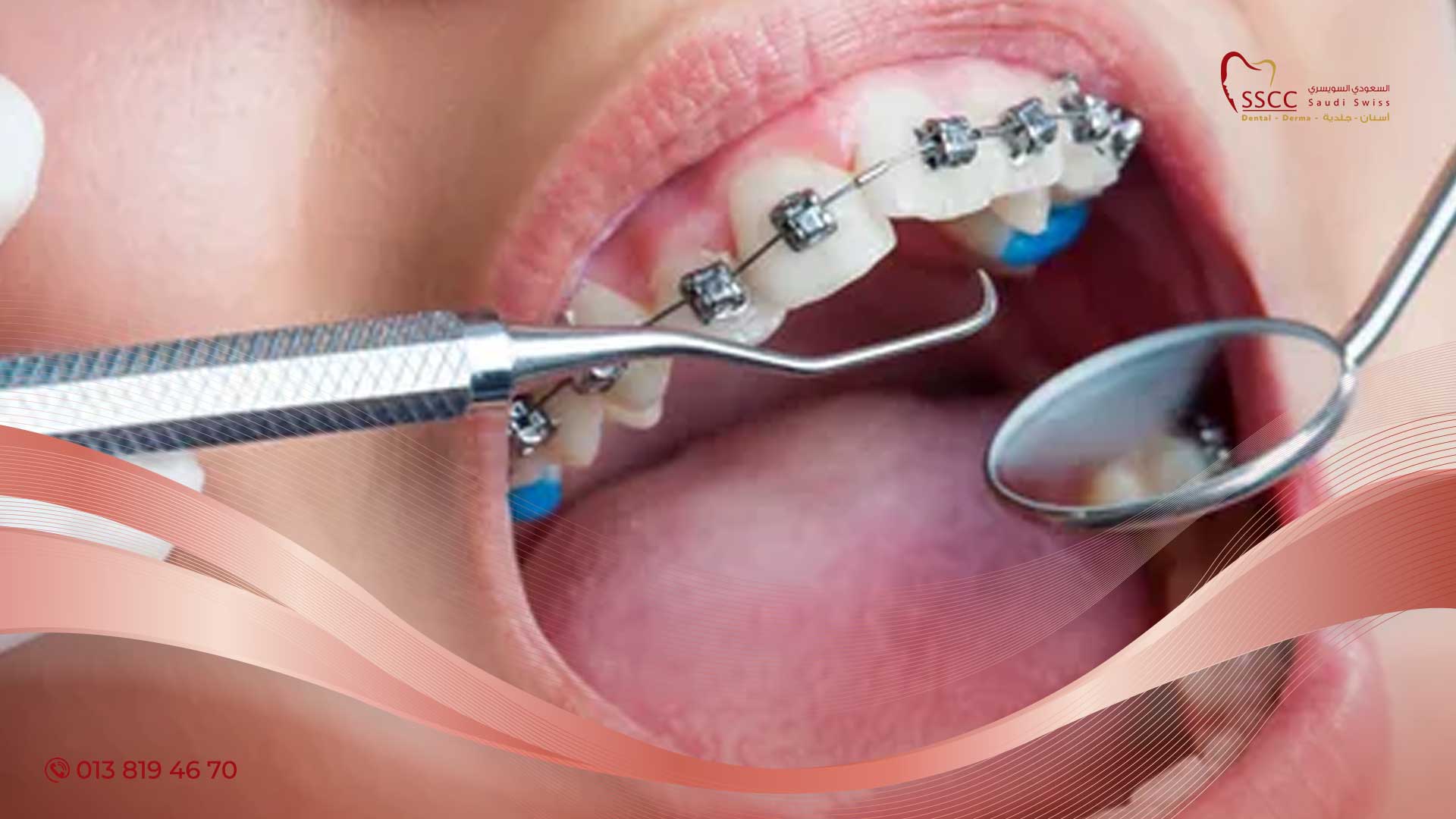 كيف تتم علاج جذور الاسنان
