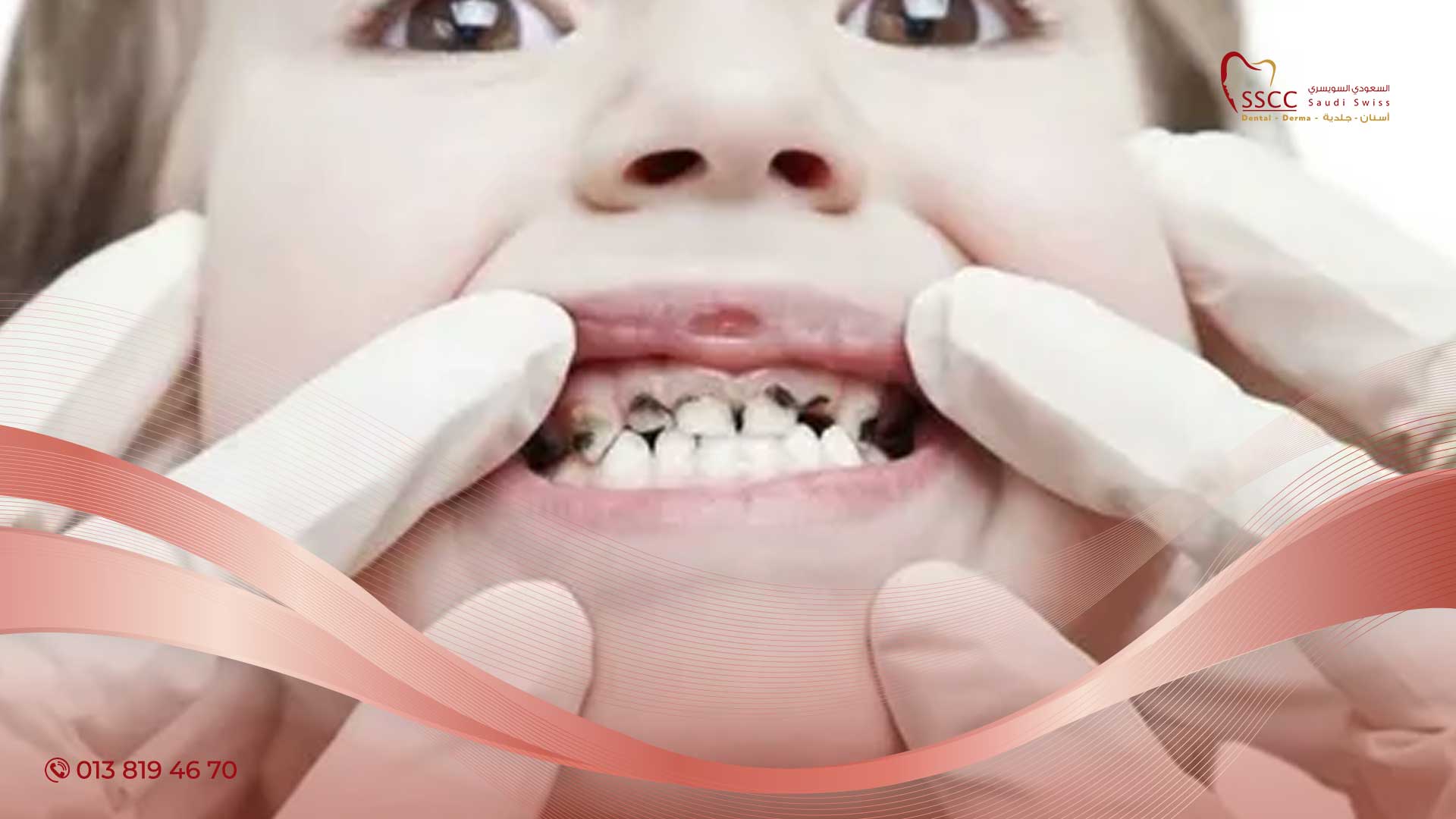 فلورايد-الاسنان