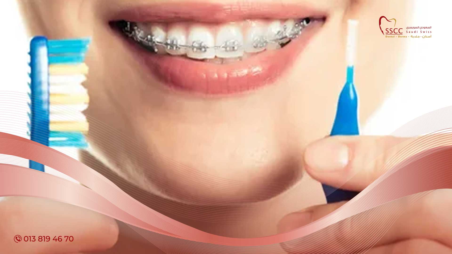 مثبت الاسنان بعد التقويم
