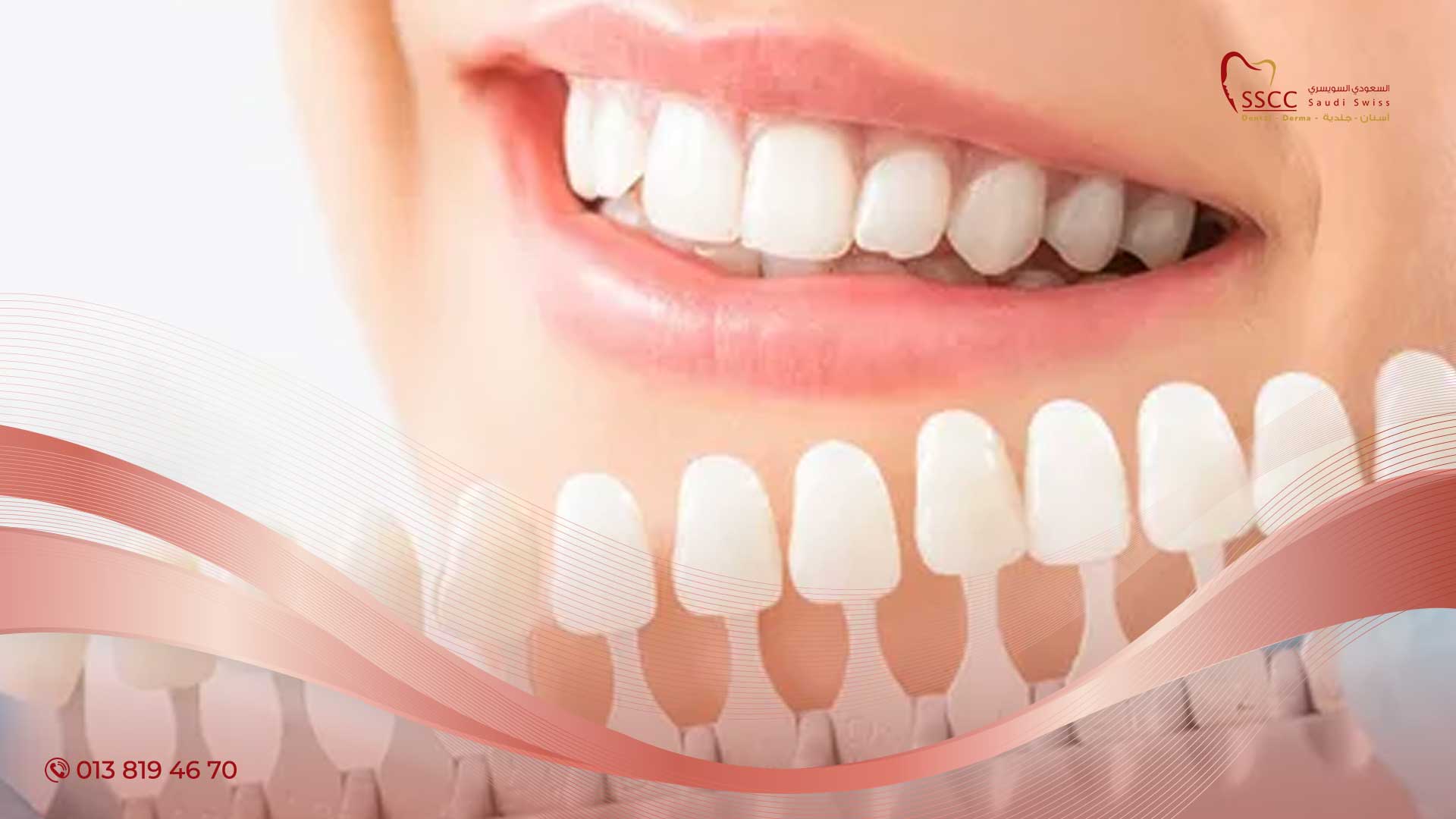كل المعلومات حول تلبيس الأسنان