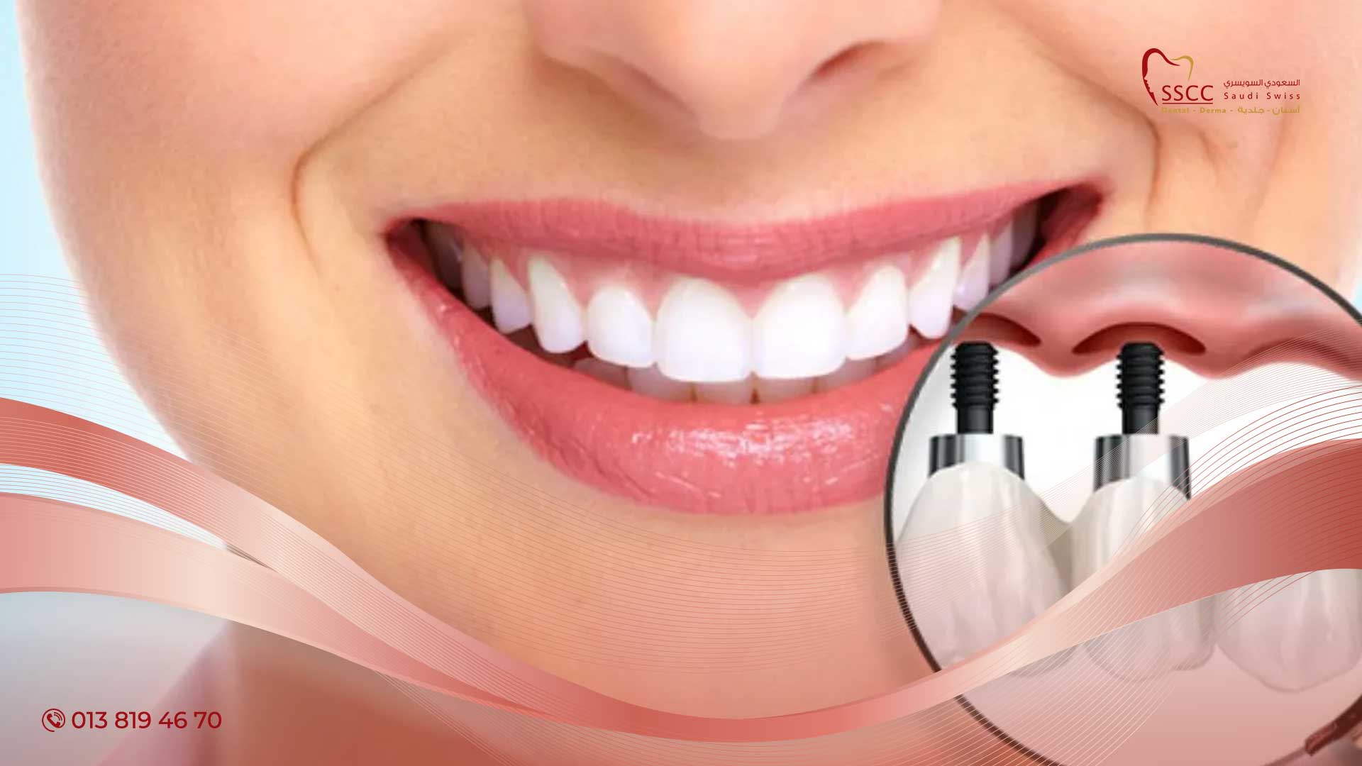 عيادات زراعة الاسنان