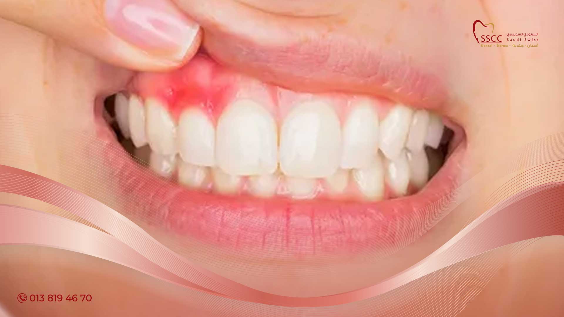 التهاب اللثة