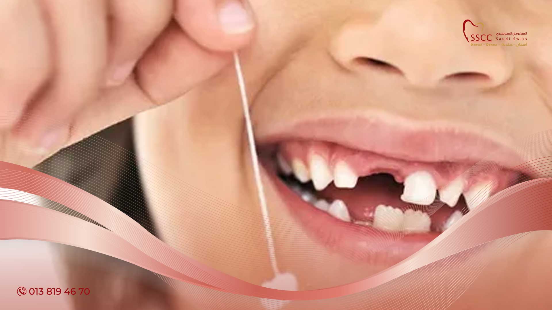 سقوط الاسنان