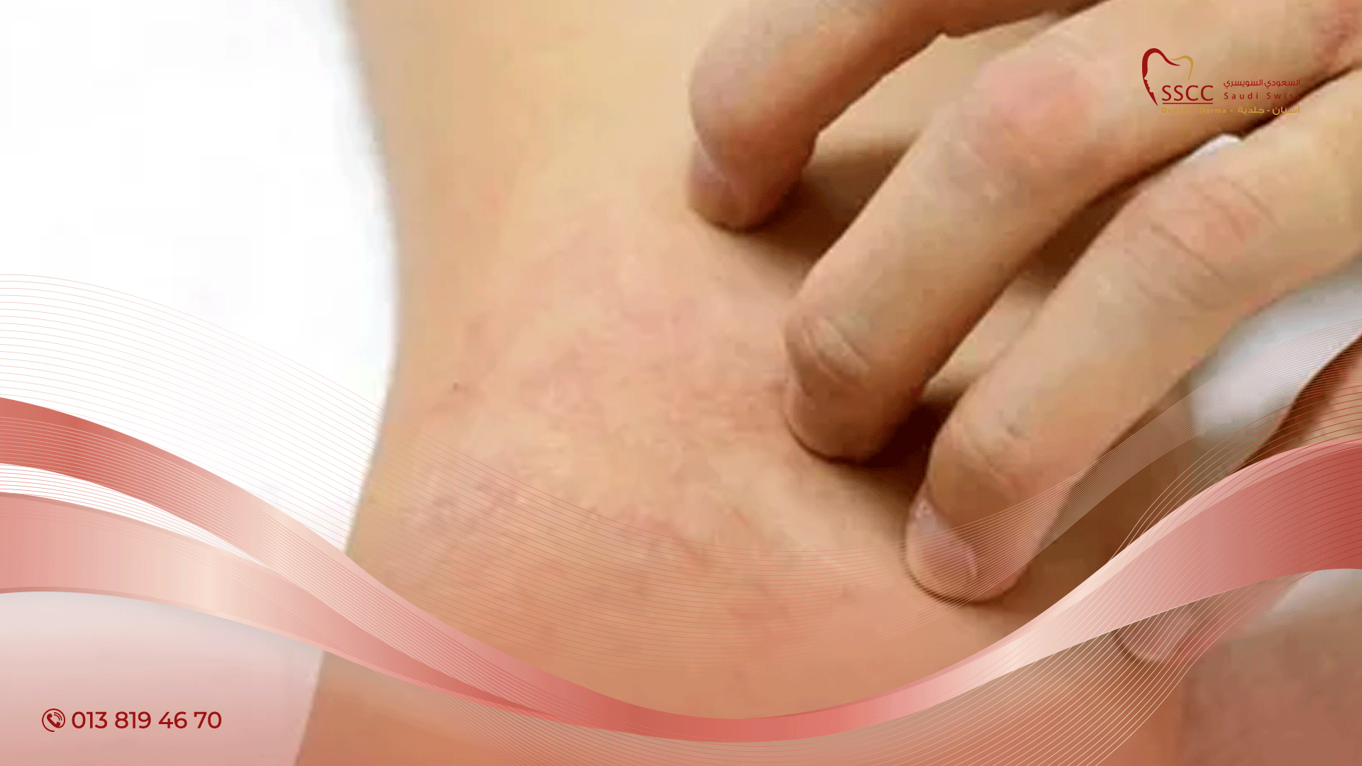 علاج تهيج الجلد